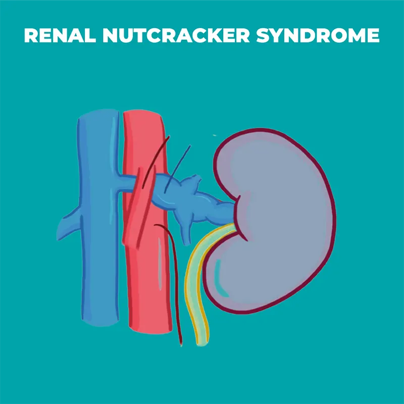 Nutcracker Syndrome Symptoms, Risk Factors, and Treatment